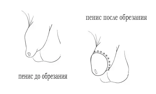 Мастурбировать После Обрезания